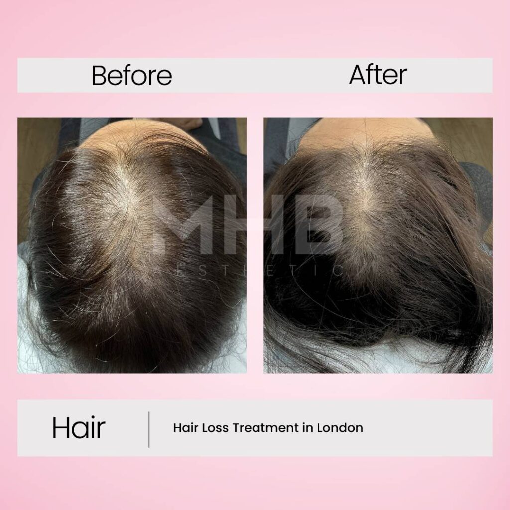 Hair loss treatment in London