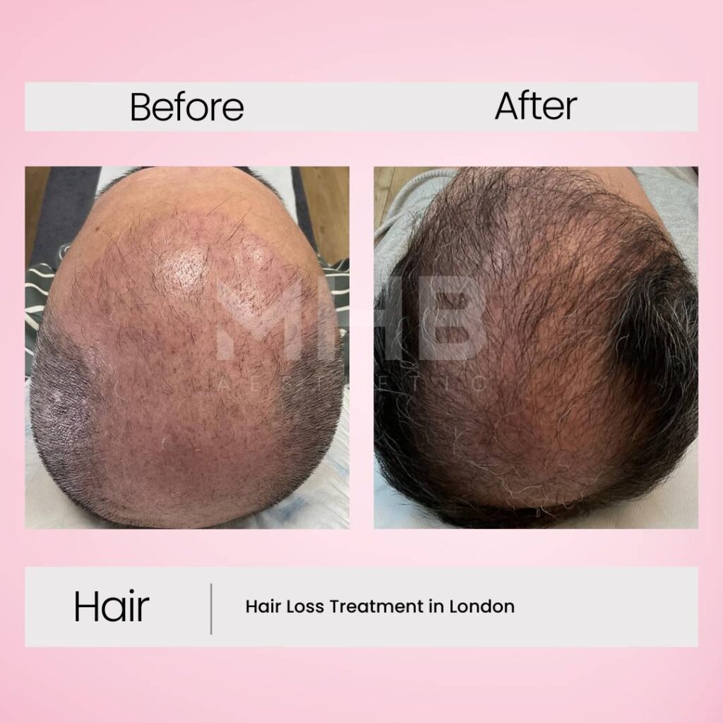 Hair loss treatment in London 2