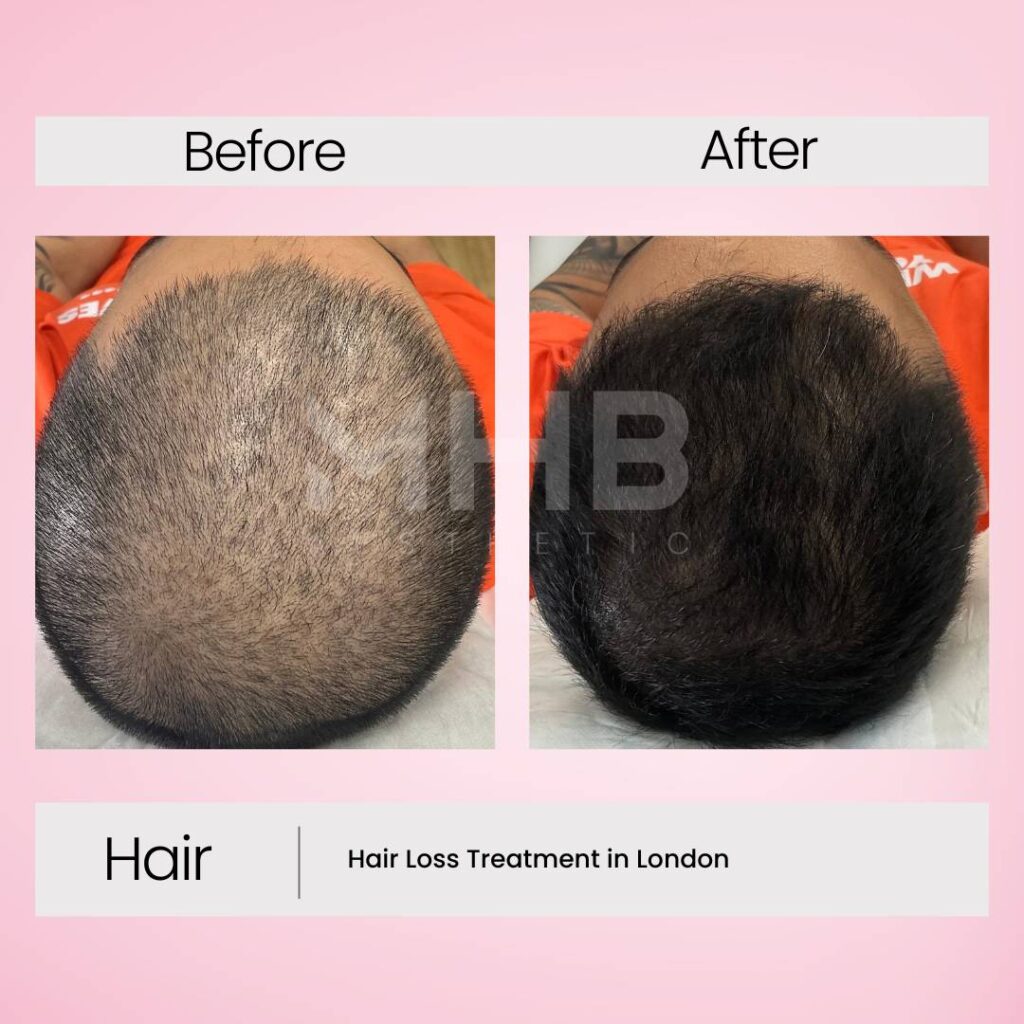 Hair loss treatment in London