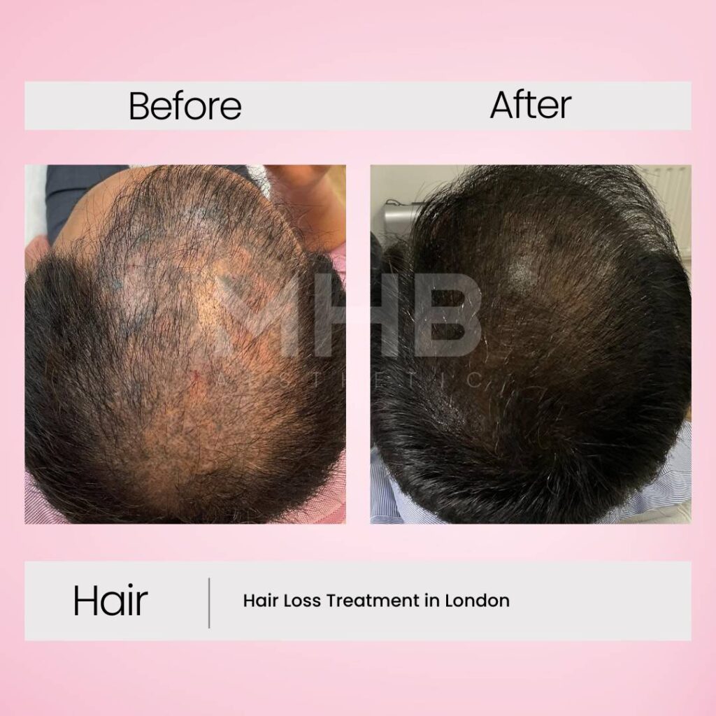 Hair loss treatment in London 5