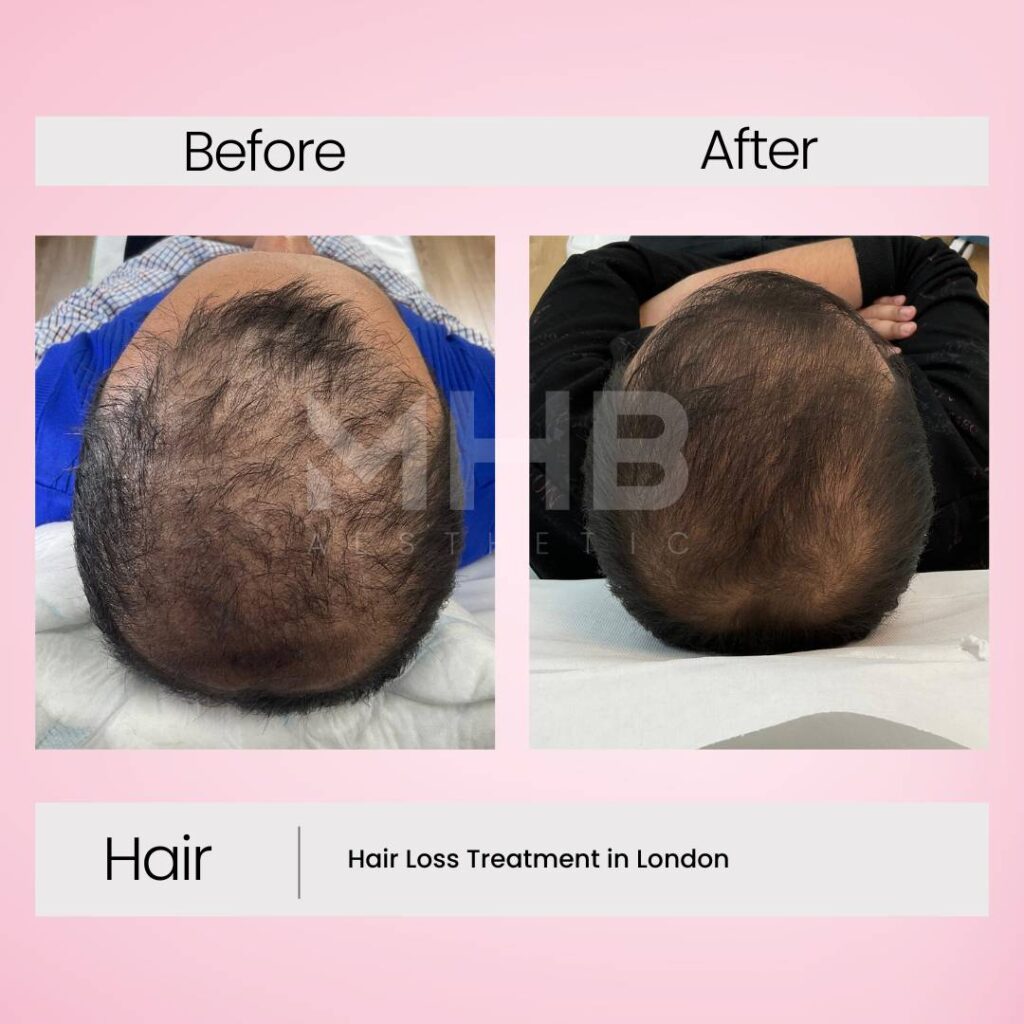 Hair loss treatment in London 7