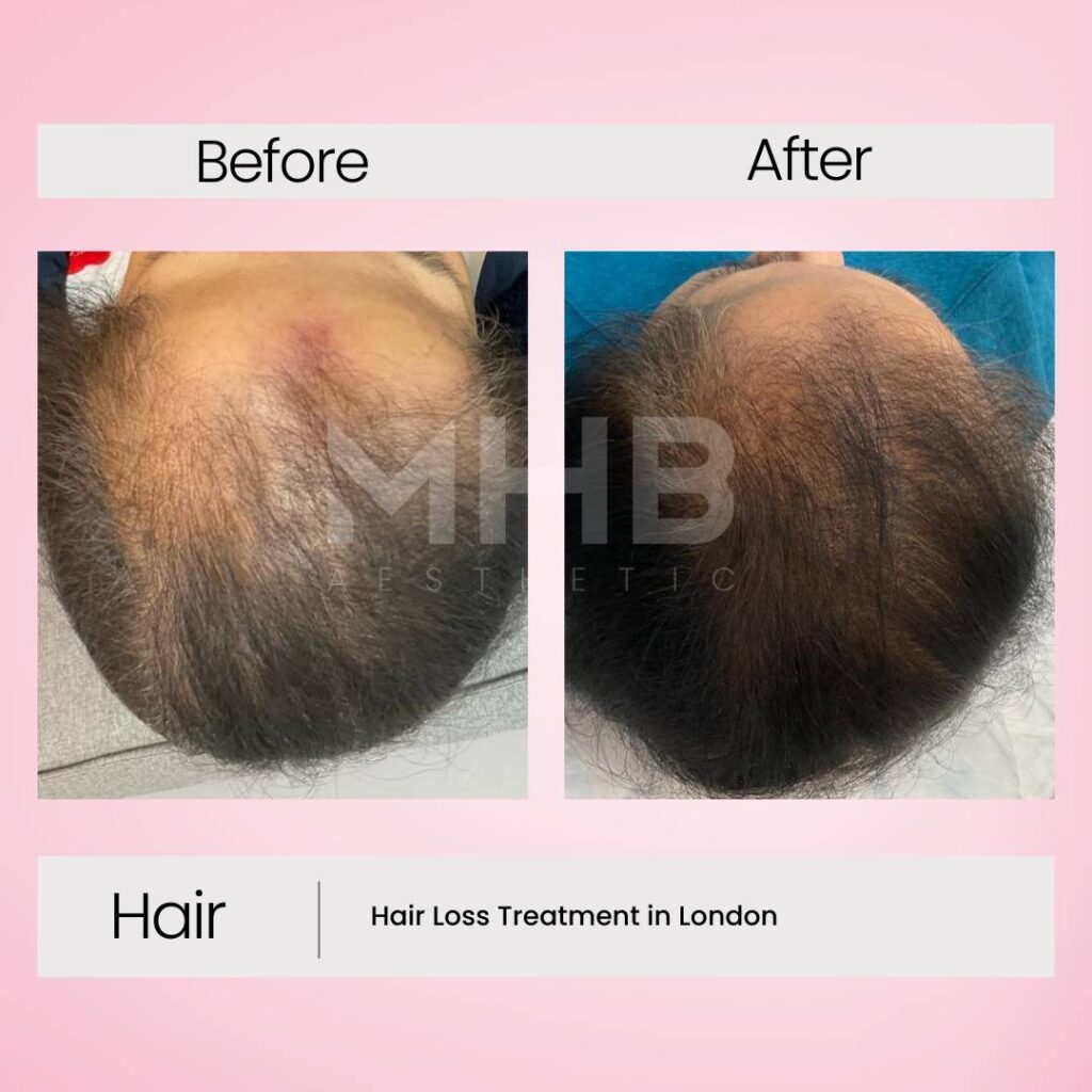 Hair loss treatment in London 9