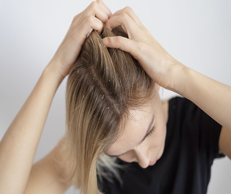 Dandruff Treatment