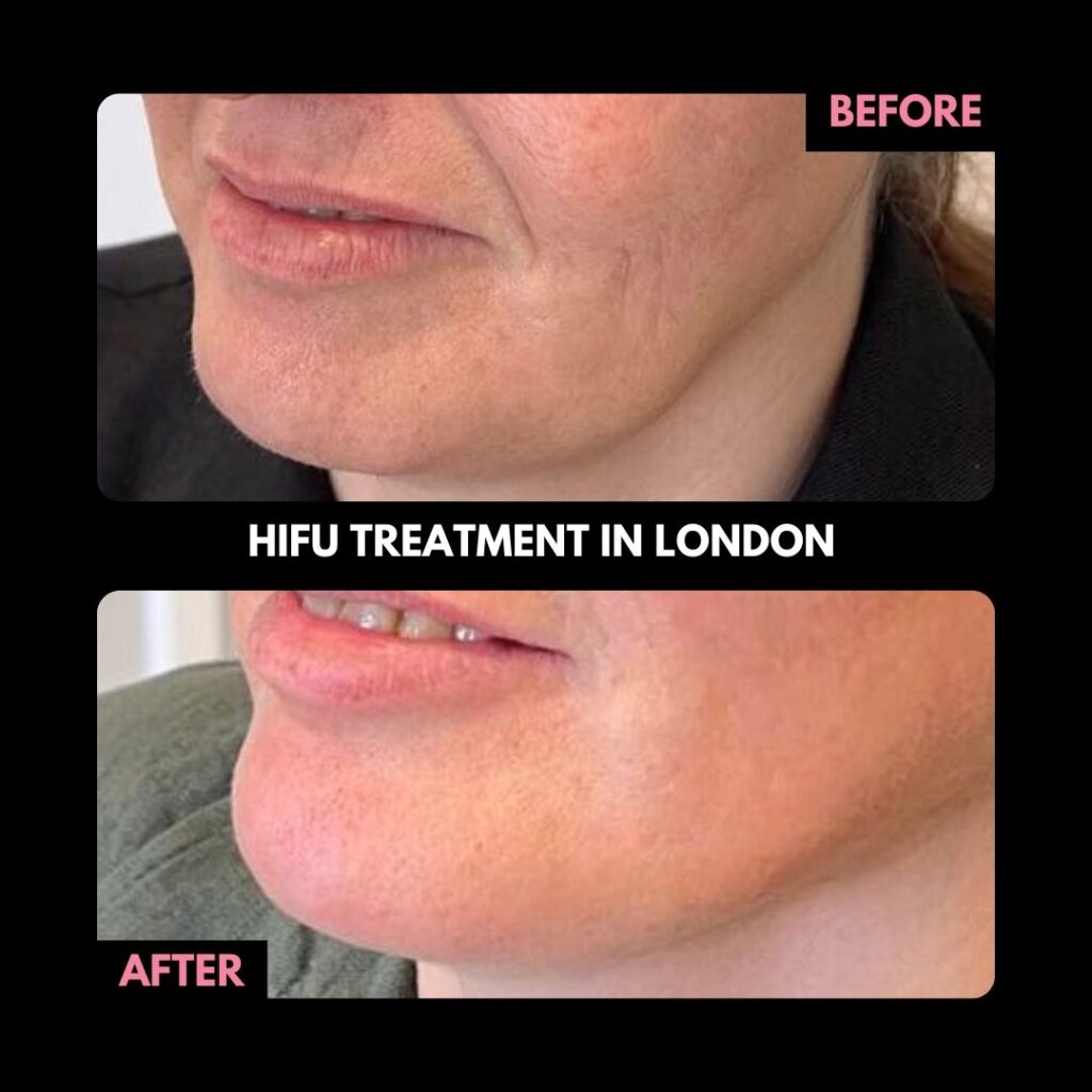Hifu Treatment in London Before and After