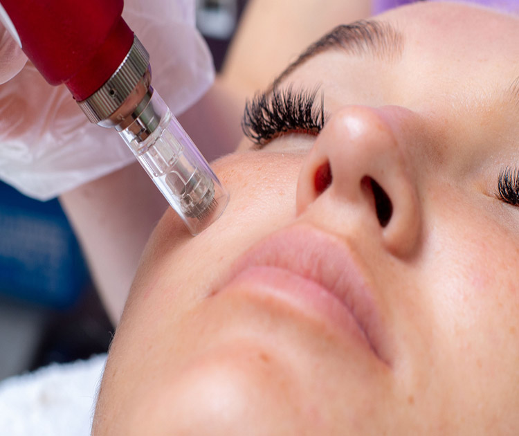 microneedling-aesthetics-treatments