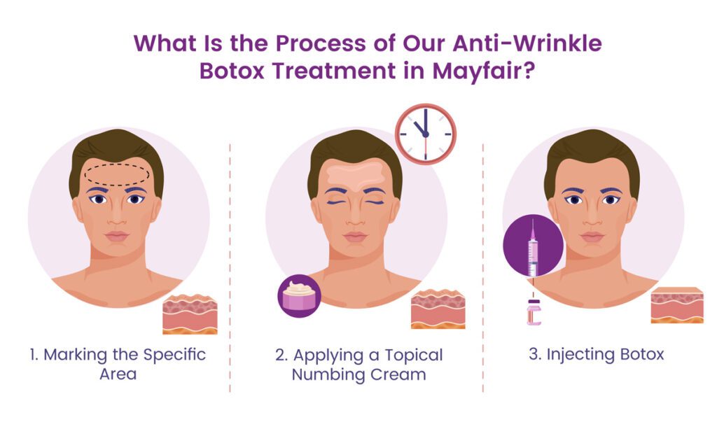 Anti Wrinkle Botox in Mayfair aProcess