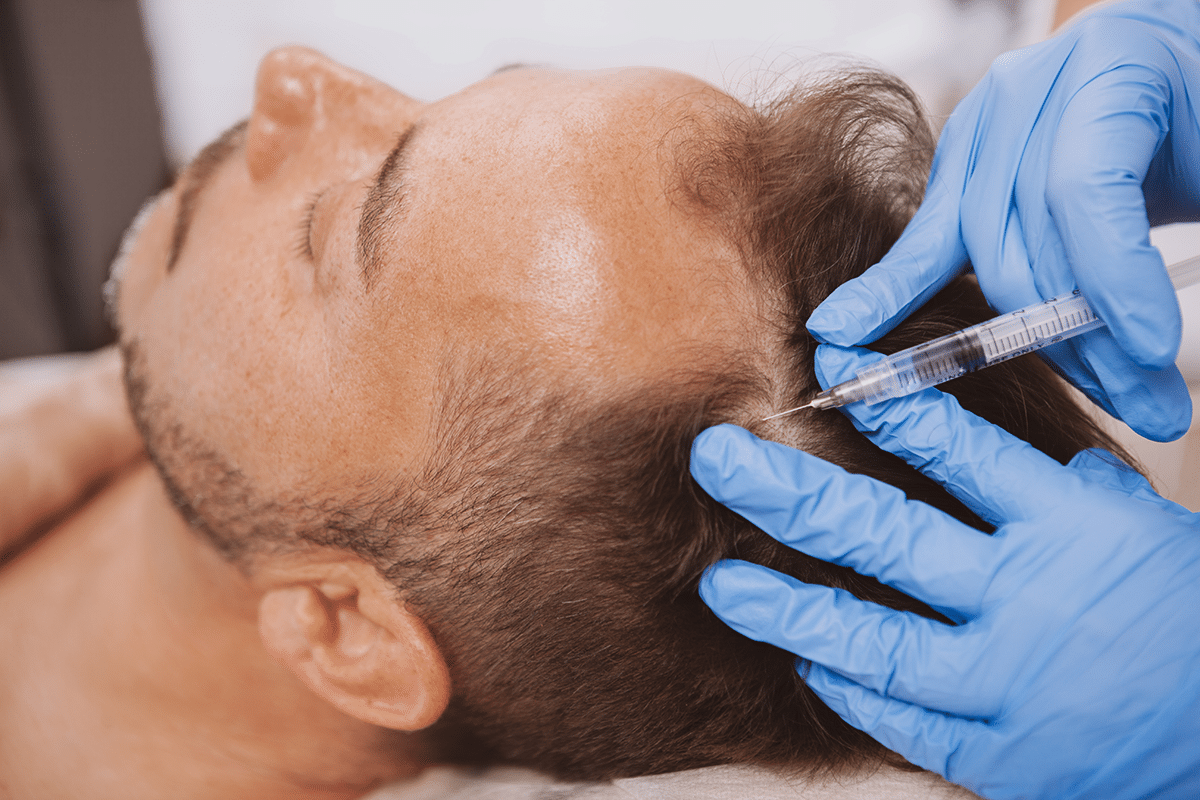 PRP Hair Treatment in london