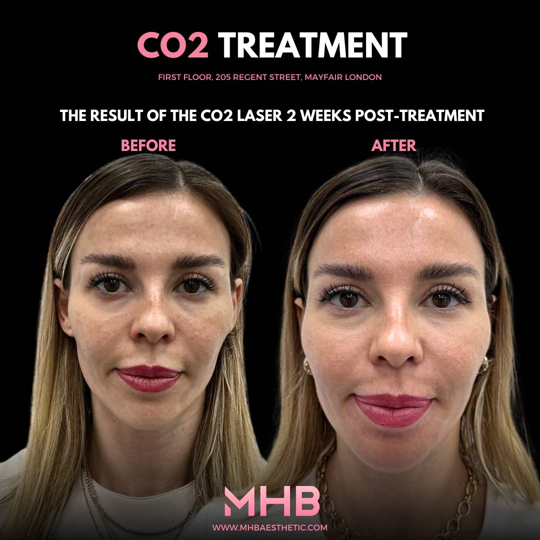 CO2 Treatment London