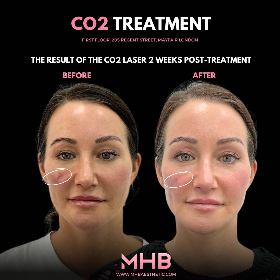 CO2 Treatment London