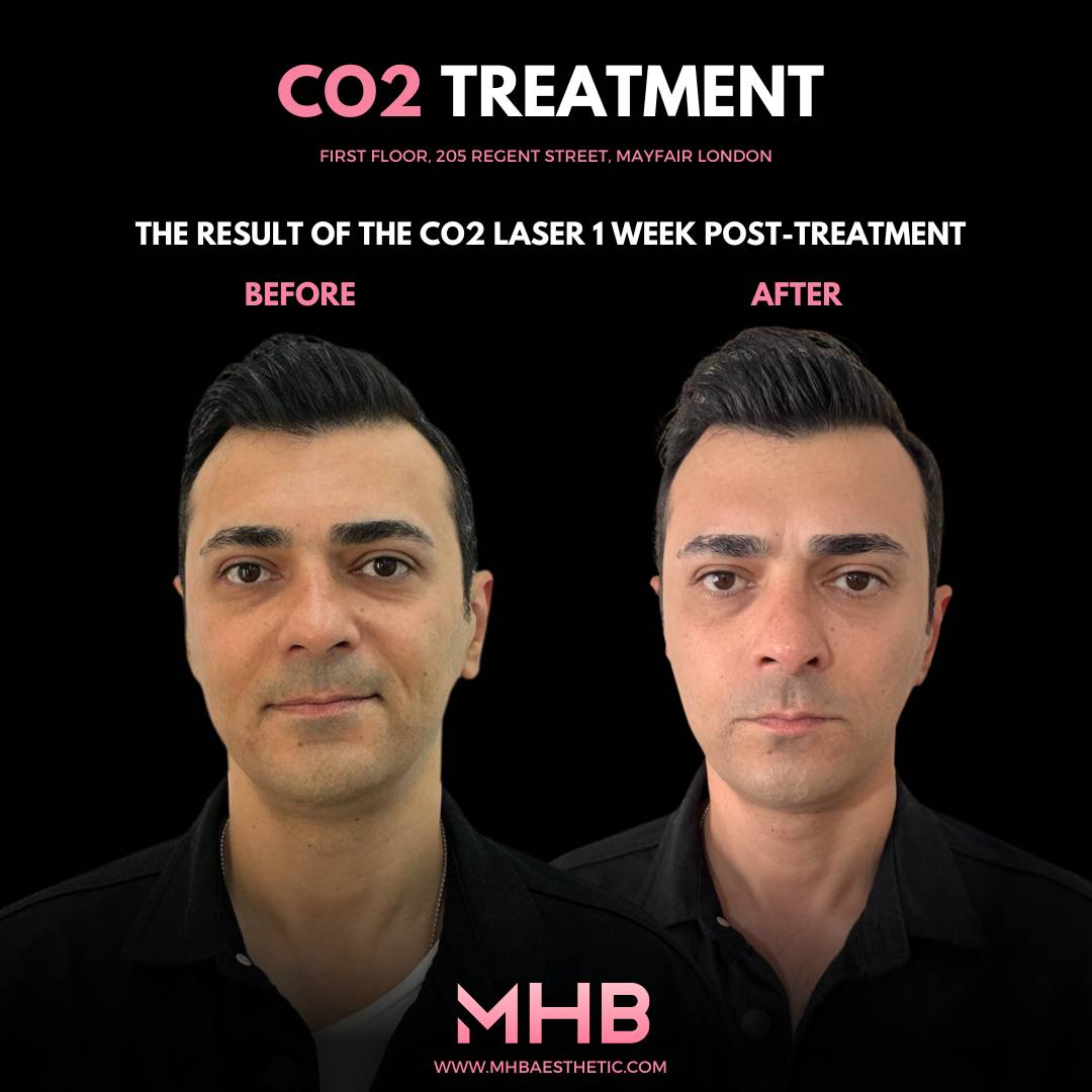 CO2 Treatment London