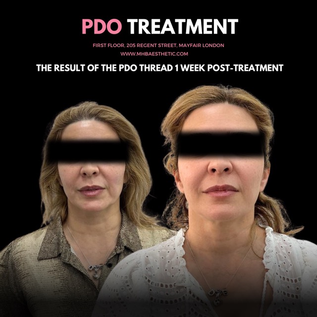 PDO Thread Treatment in London Result