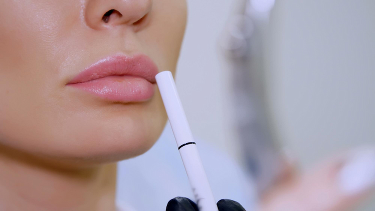 the process of Cannula Lip Filler 