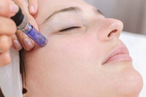 Microneedling in London