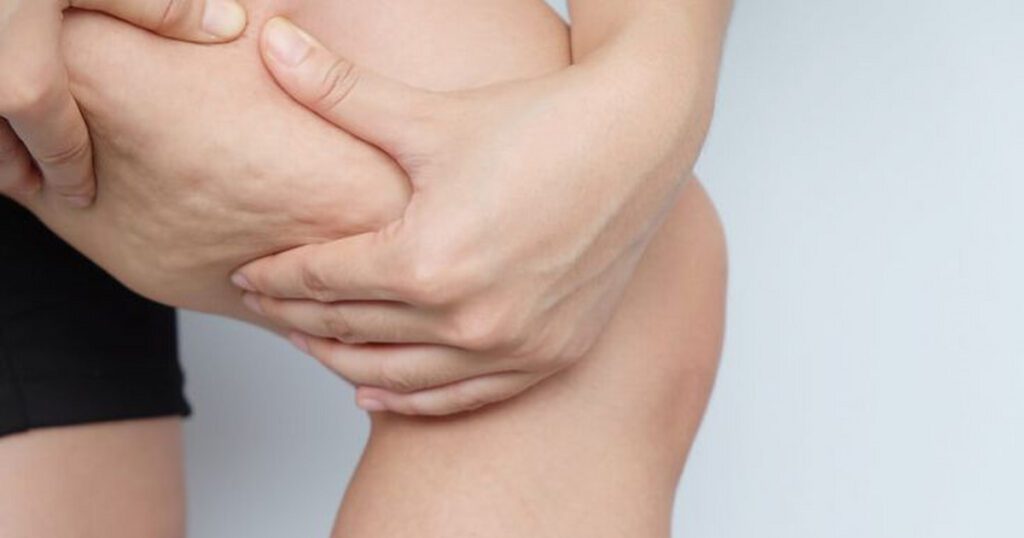 Cellulite treatments