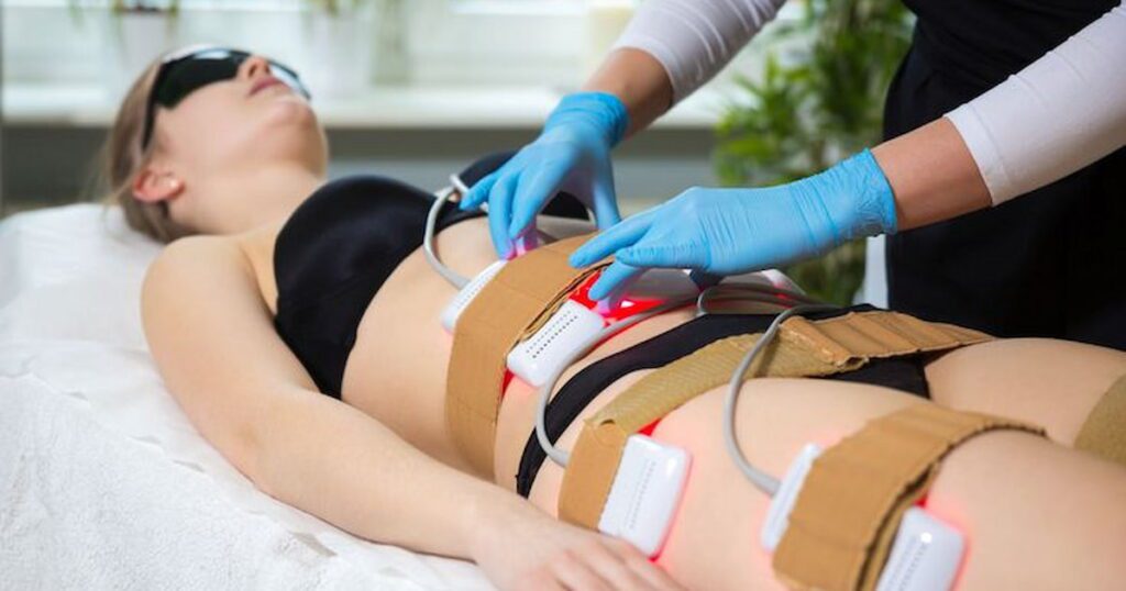 laser lipo