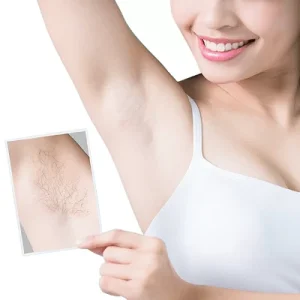 Laser Hair Removal in Westminster 1