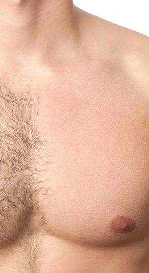 laser-hair-removal-Kensington man